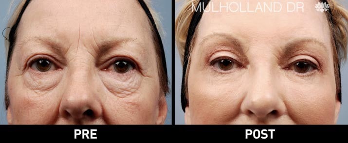 facial fat grafting before and after