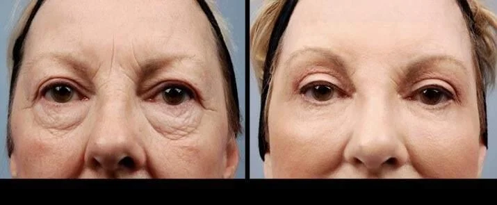 facial fat grafting before and after