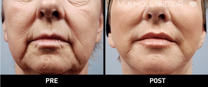 facial fat grafting before and after