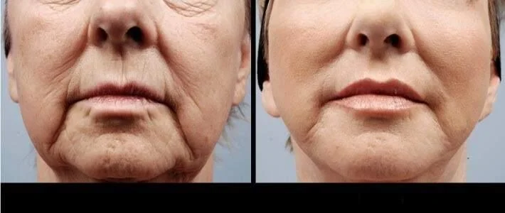 facial fat grafting before and after