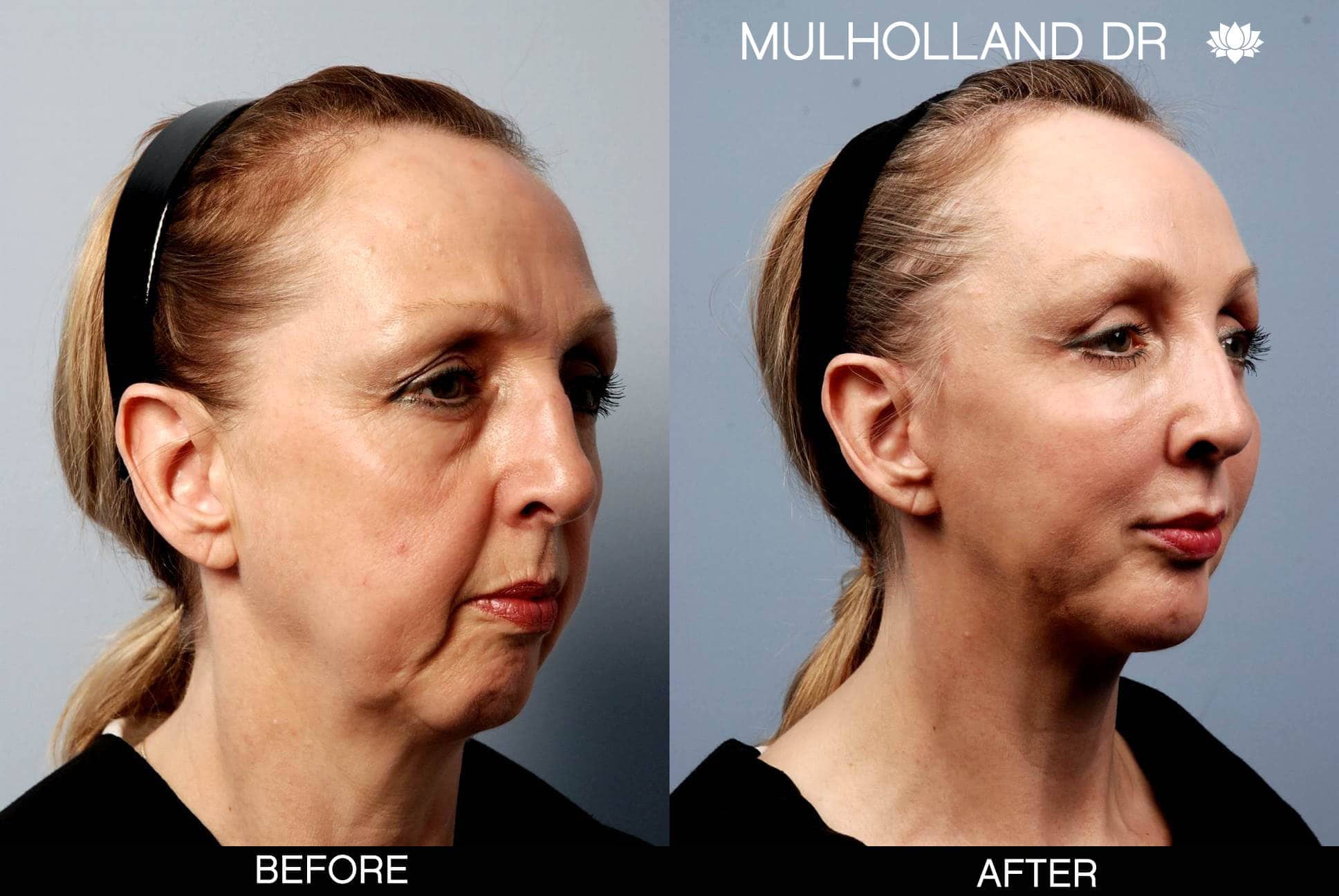 facial fat grafting before and after