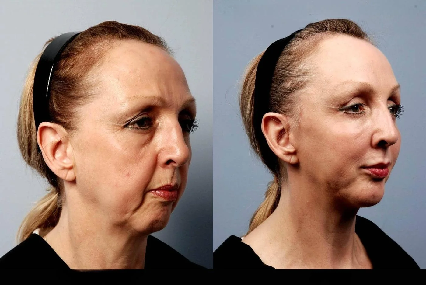 facial fat grafting before and after