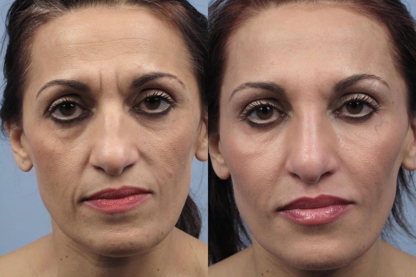 Dermal Fillers in Toronto Before and After. Image 1