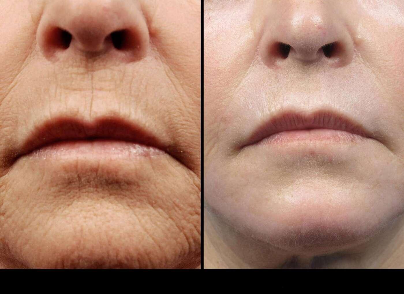 Dermal Fillers in Toronto Before and After. Image 10