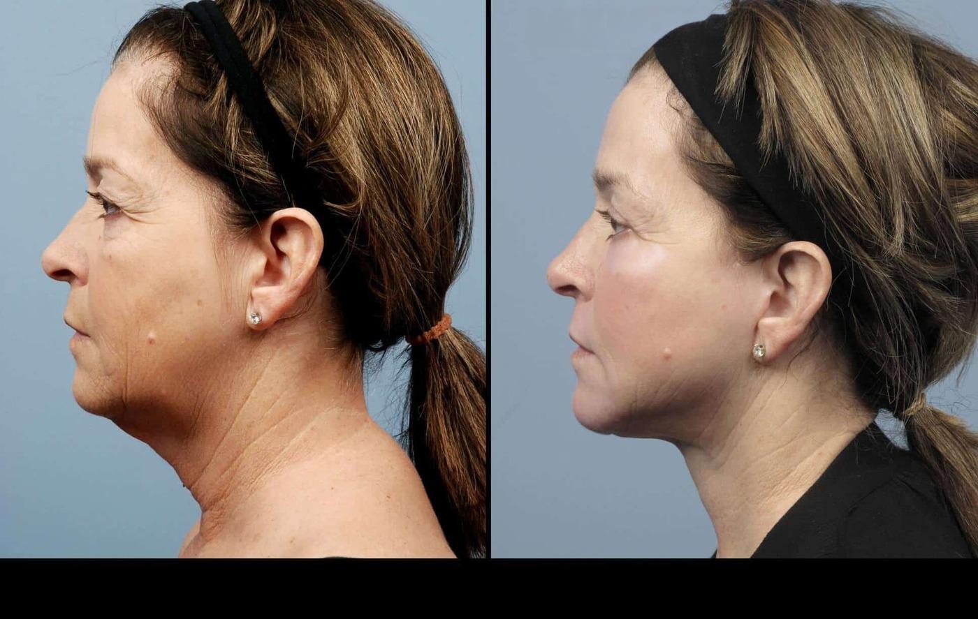 Dermal Fillers in Toronto Before and After. Image 11
