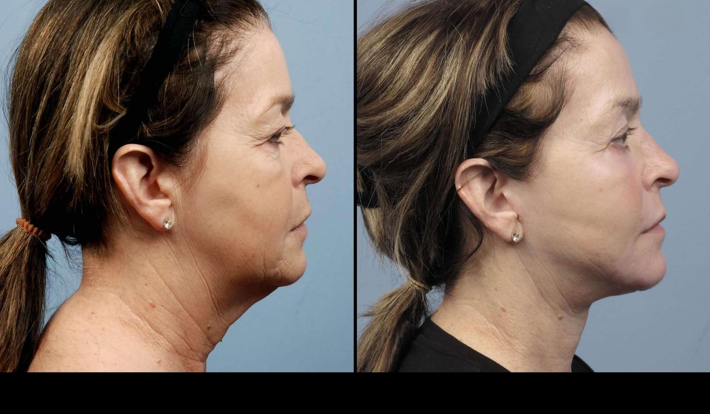 Dermal Fillers in Toronto Before and After. Image 12