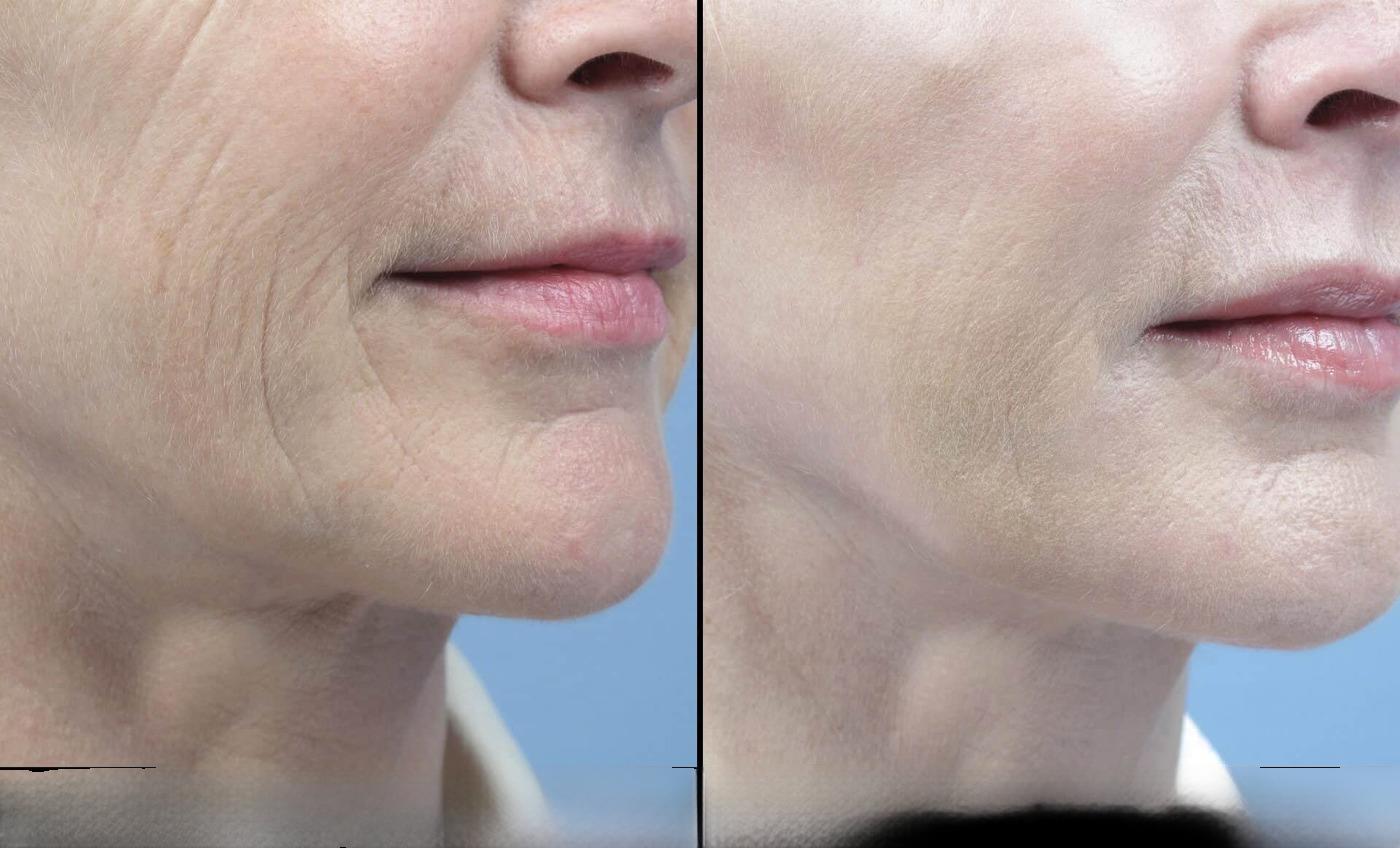 Dermal Fillers in Toronto Before and After. Image 16