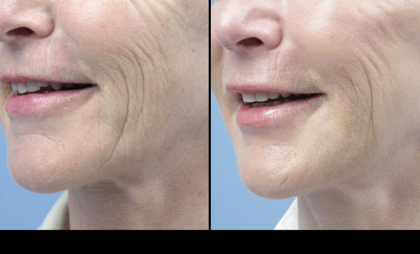 Dermal Fillers in Toronto Before and After. Image 17