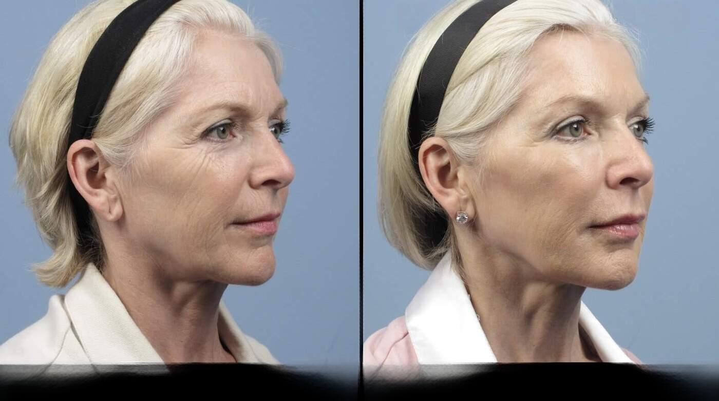 Dermal Fillers in Toronto Before and After. Image 19