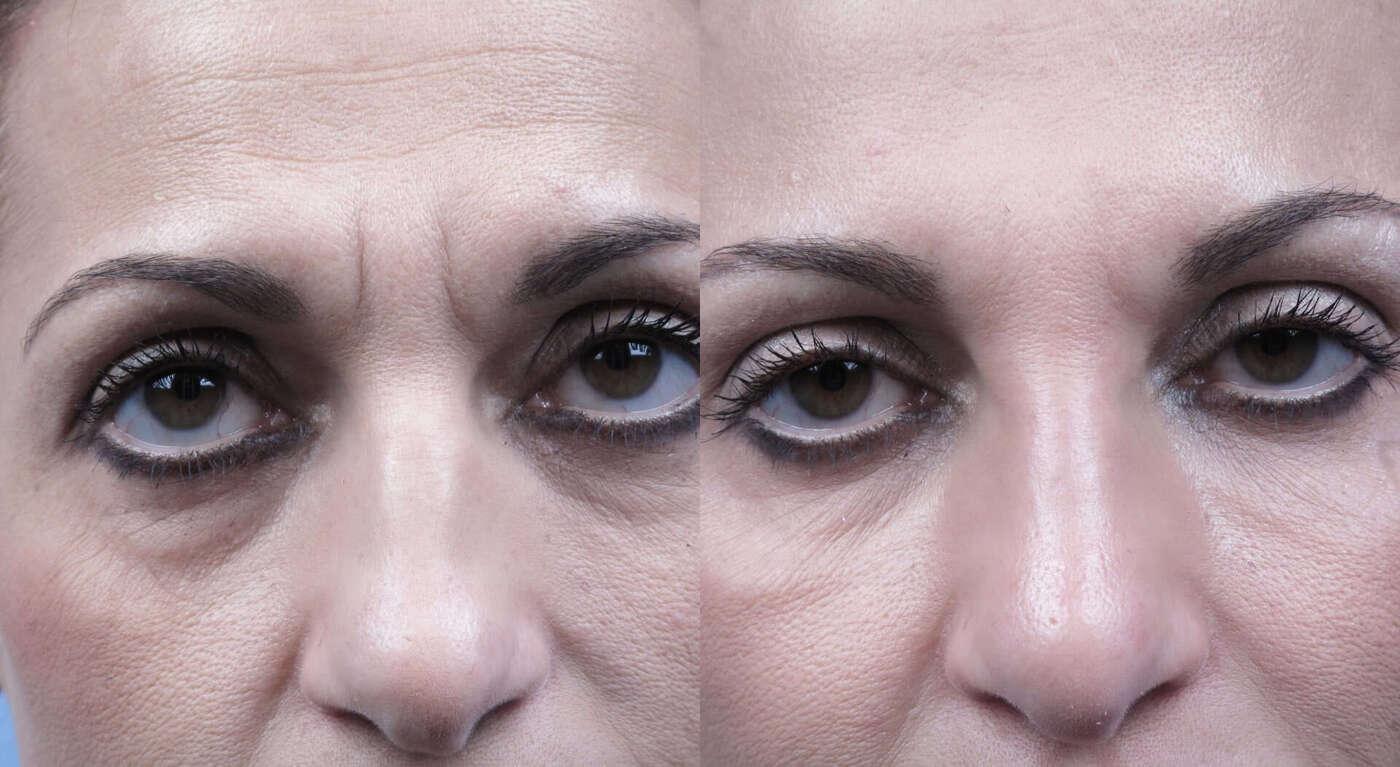 Dermal Fillers in Toronto Before and After. Image 2