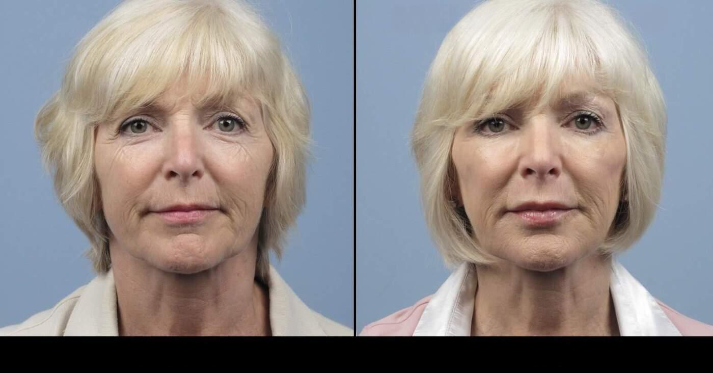 Dermal Fillers in Toronto Before and After. Image 21