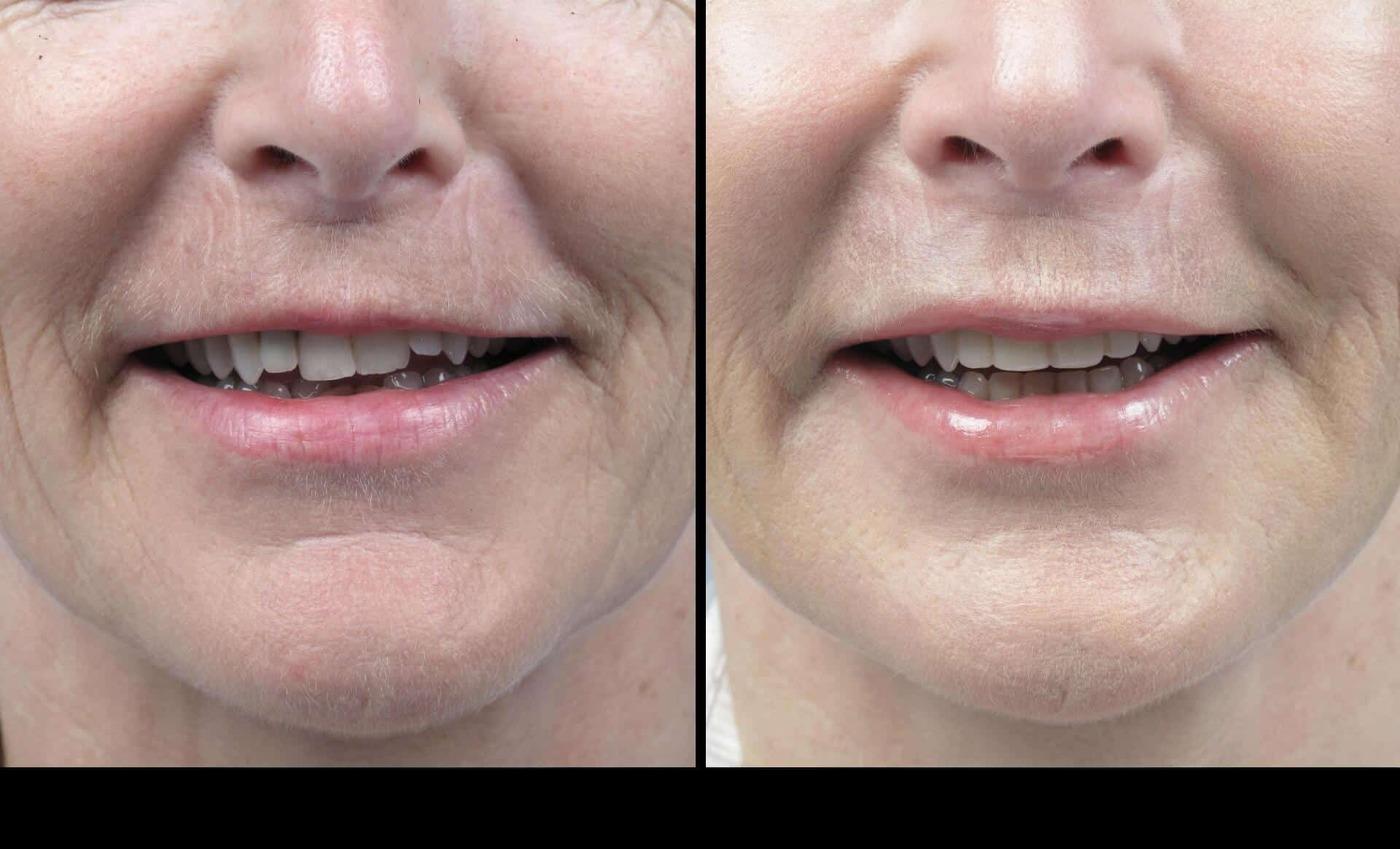 Dermal Fillers in Toronto Before and After. Image 22