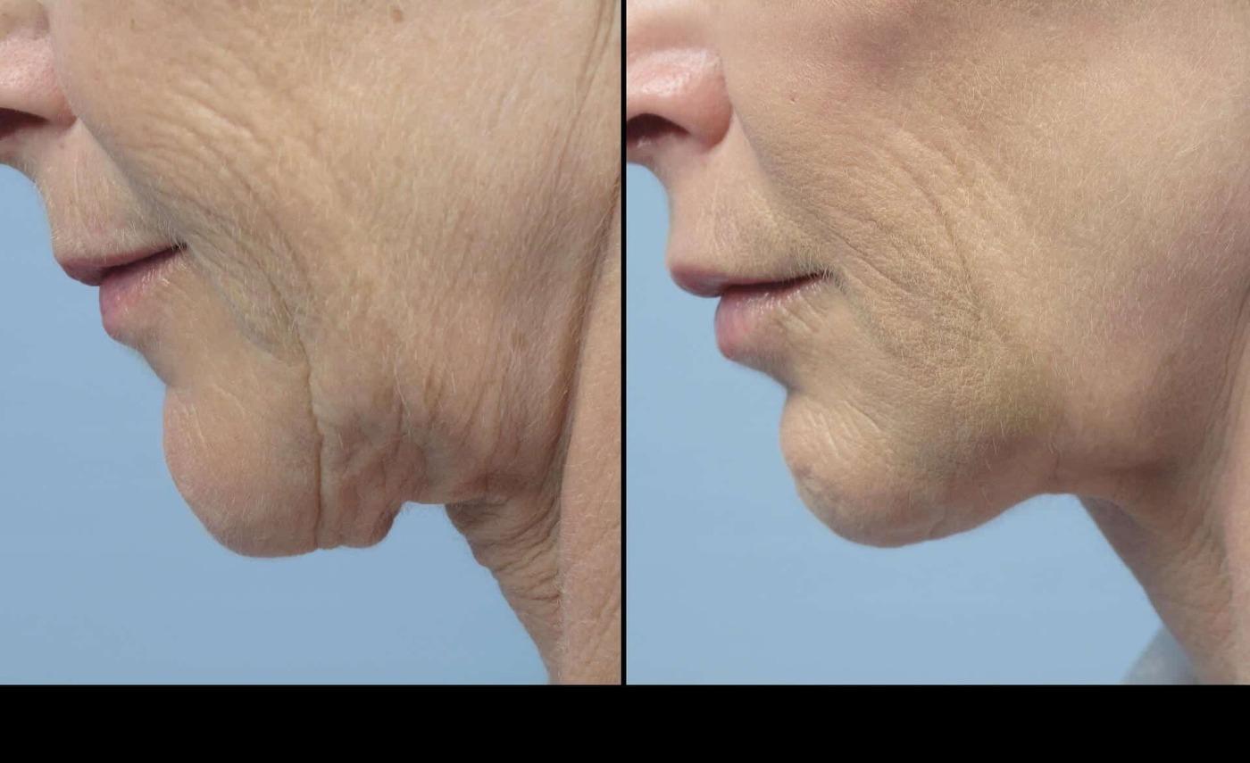 Dermal Fillers in Toronto Before and After. Image 23