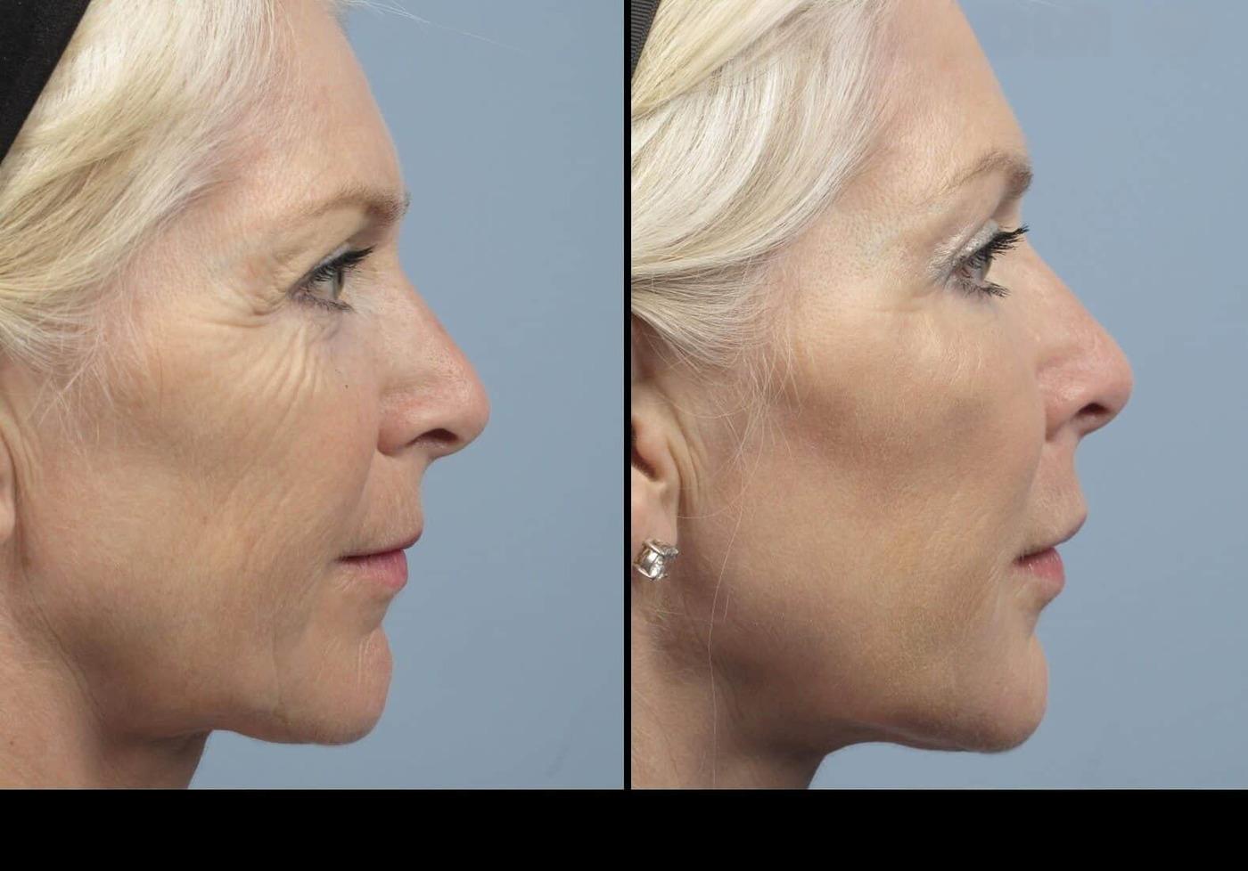 Dermal Fillers in Toronto Before and After. Image 24