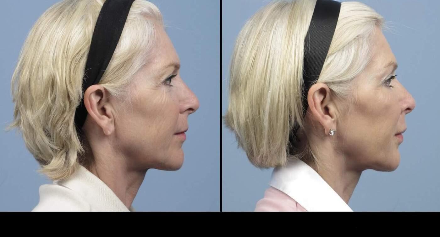 Dermal Fillers in Toronto Before and After. Image 25