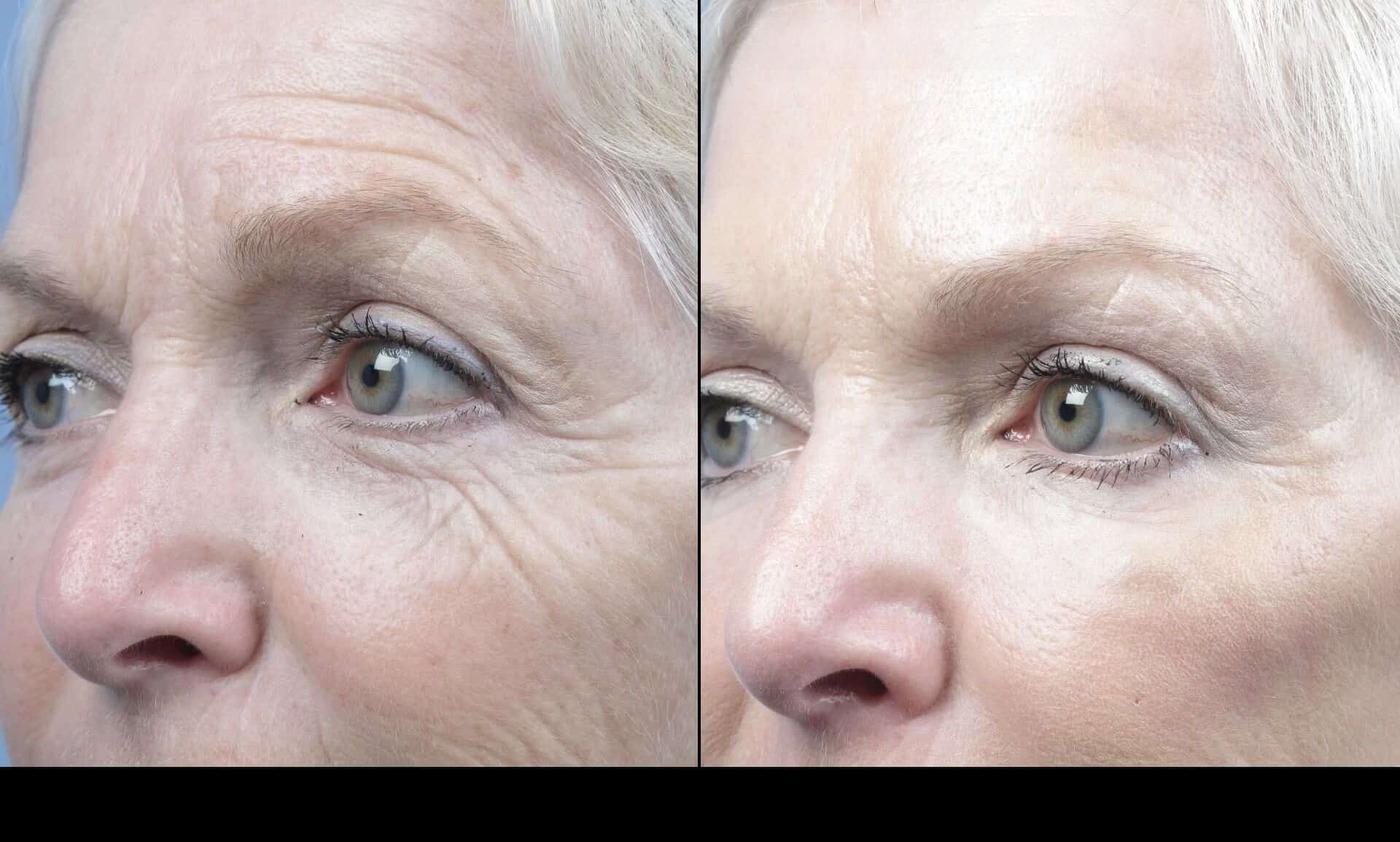Dermal Fillers in Toronto Before and After. Image 26