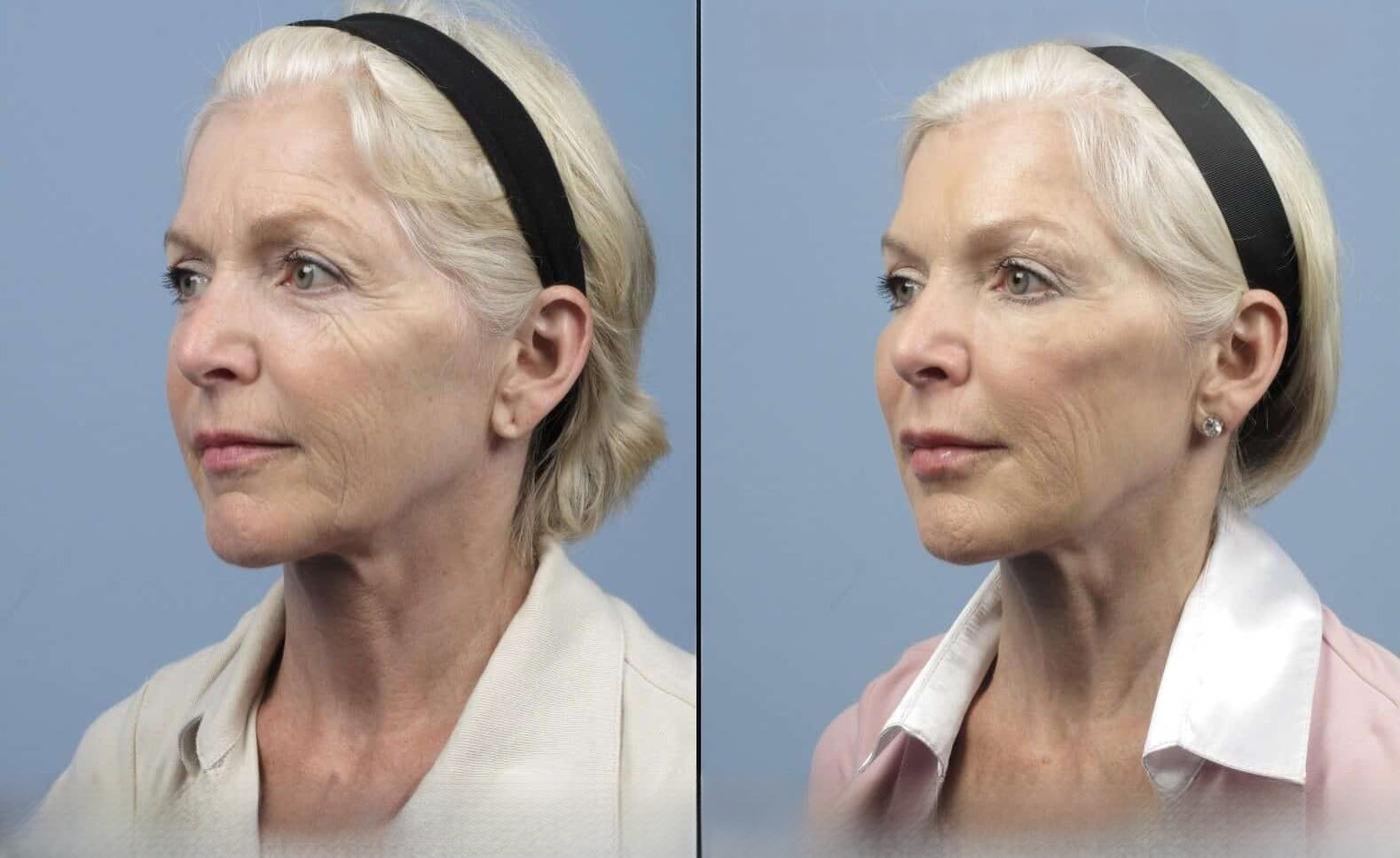 Dermal Fillers in Toronto Before and After. Image 27