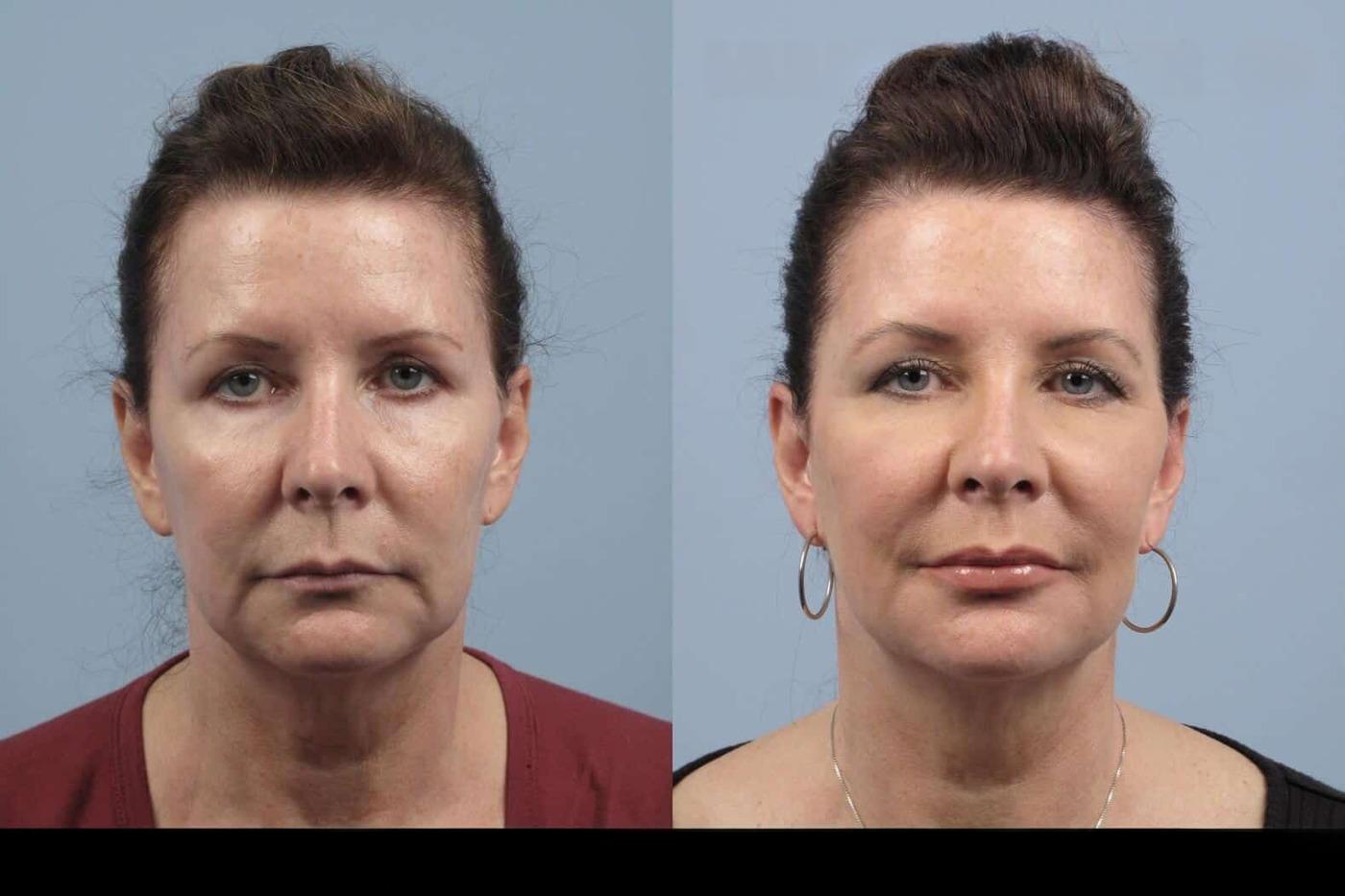 Dermal Fillers in Toronto Before and After. Image 28