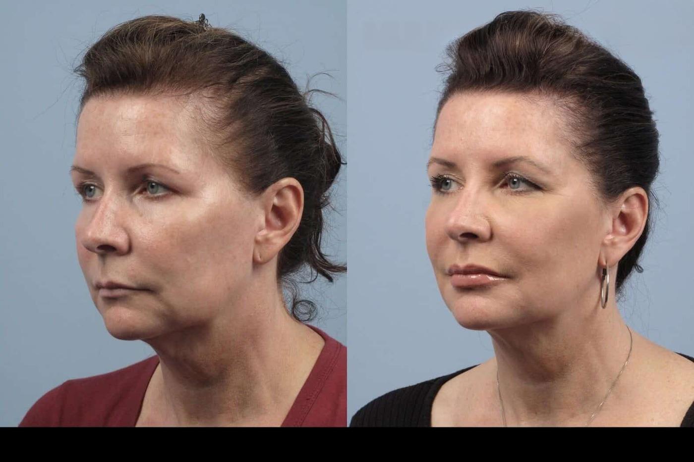 Dermal Fillers in Toronto Before and After. Image 29
