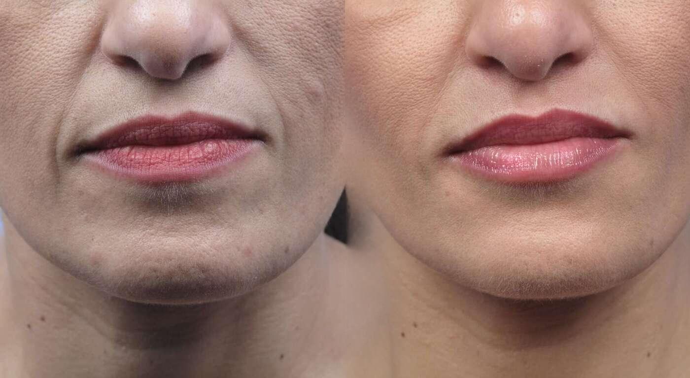 Dermal Fillers in Toronto Before and After. Image 3