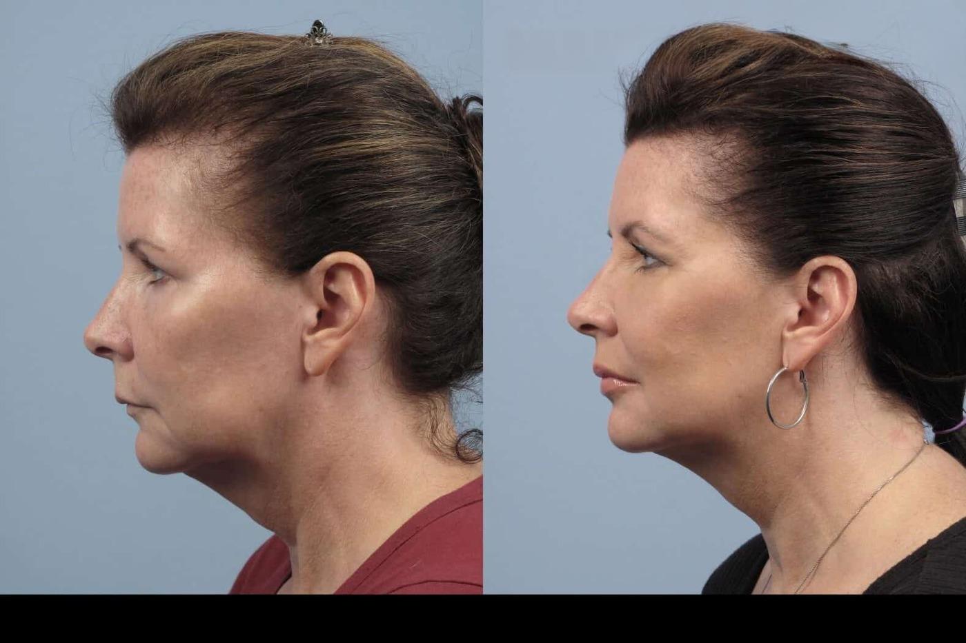 Dermal Fillers in Toronto Before and After. Image 30