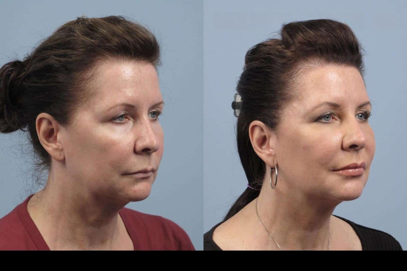 Dermal Fillers in Toronto Before and After. Image 31