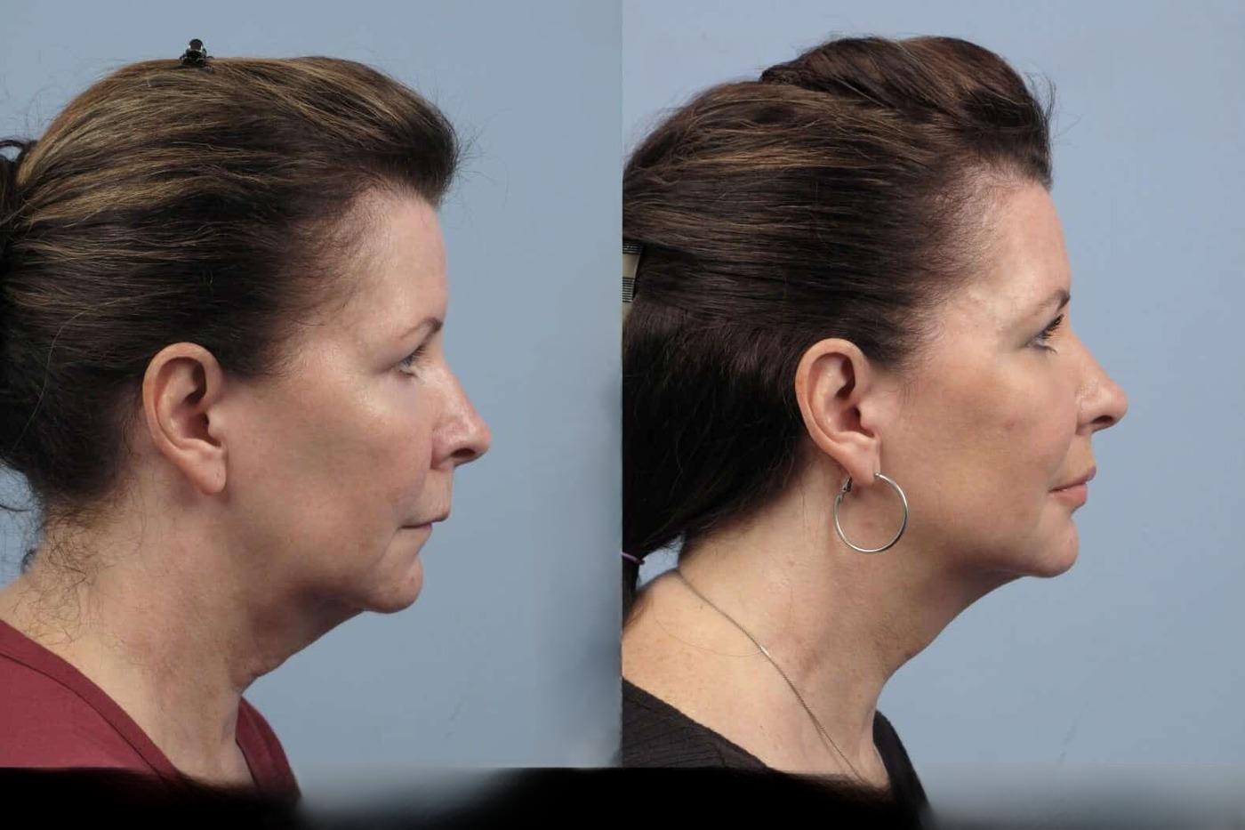 Dermal Fillers in Toronto Before and After. Image 32