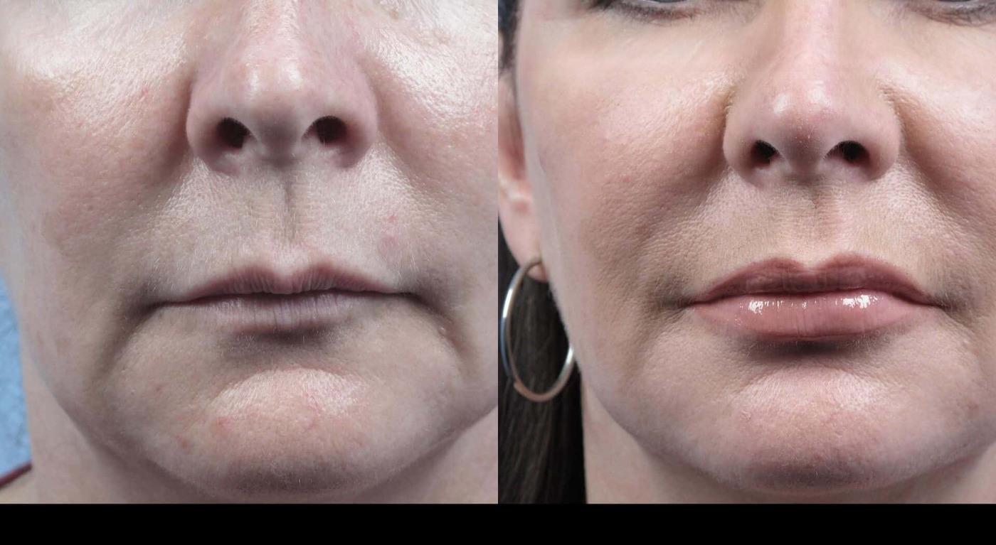Dermal Fillers in Toronto Before and After. Image 33