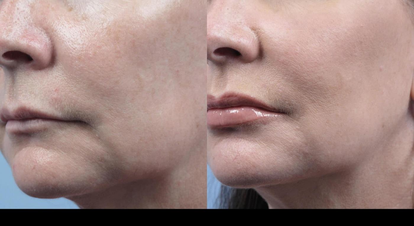 Dermal Fillers in Toronto Before and After. Image 34