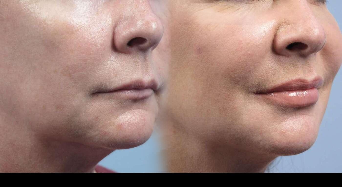 Dermal Fillers in Toronto Before and After. Image 35