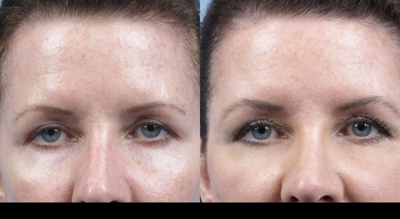 Dermal Fillers in Toronto Before and After. Image 36