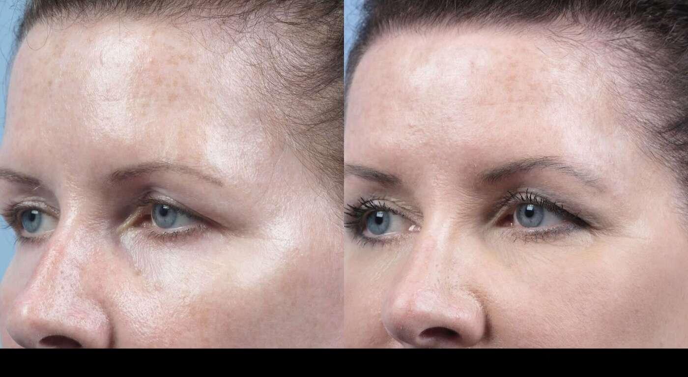 Dermal Fillers in Toronto Before and After. Image 37