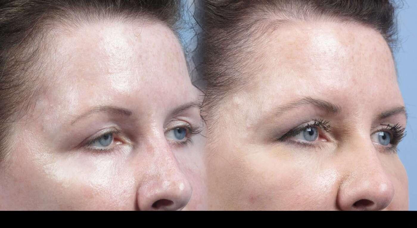 Dermal Fillers in Toronto Before and After. Image 38