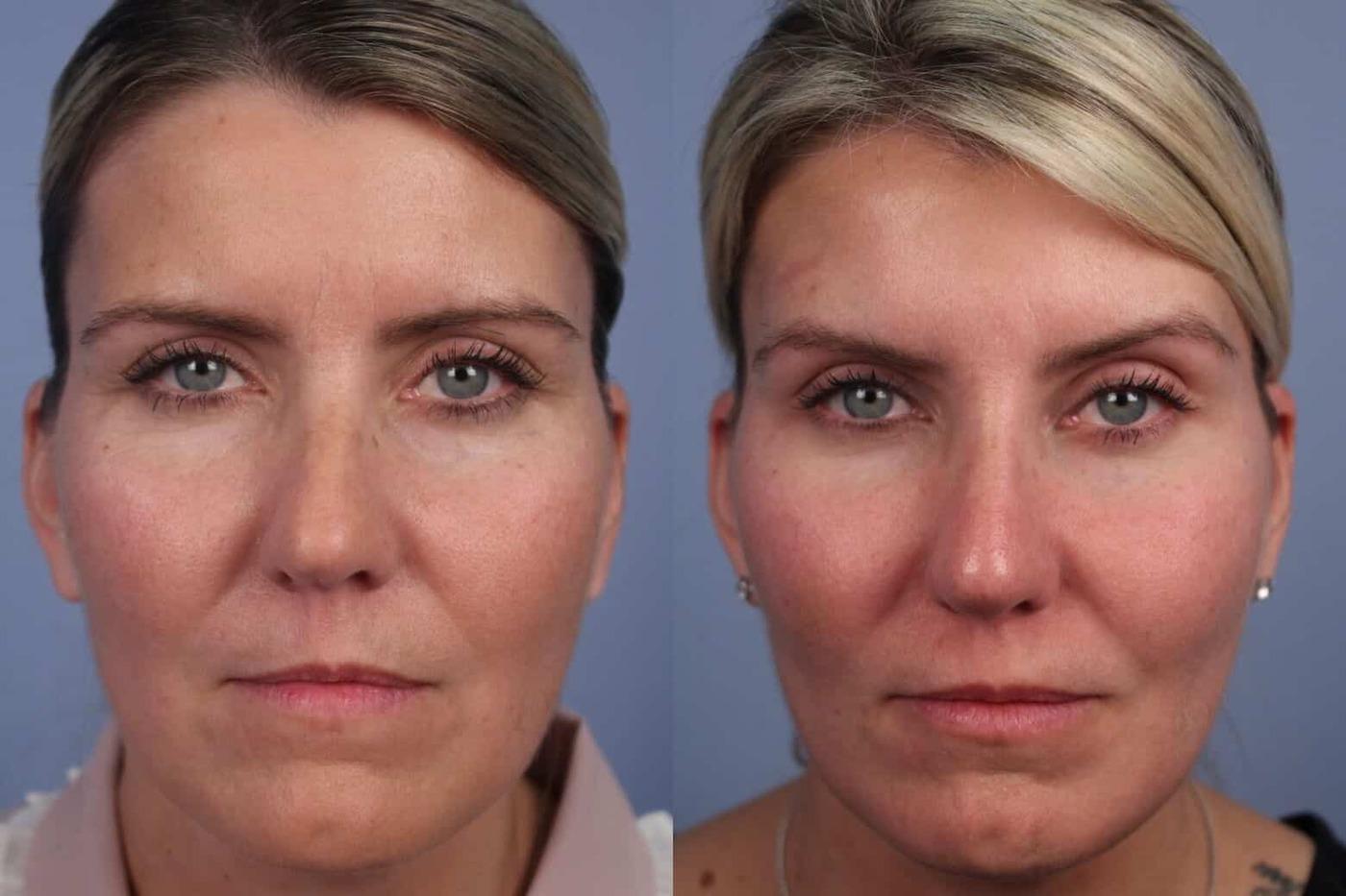 Dermal Fillers in Toronto Before and After. Image 39