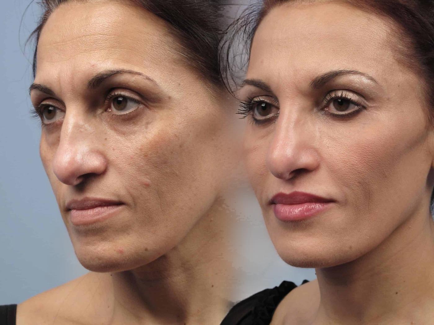 Dermal Fillers in Toronto Before and After. Image 4