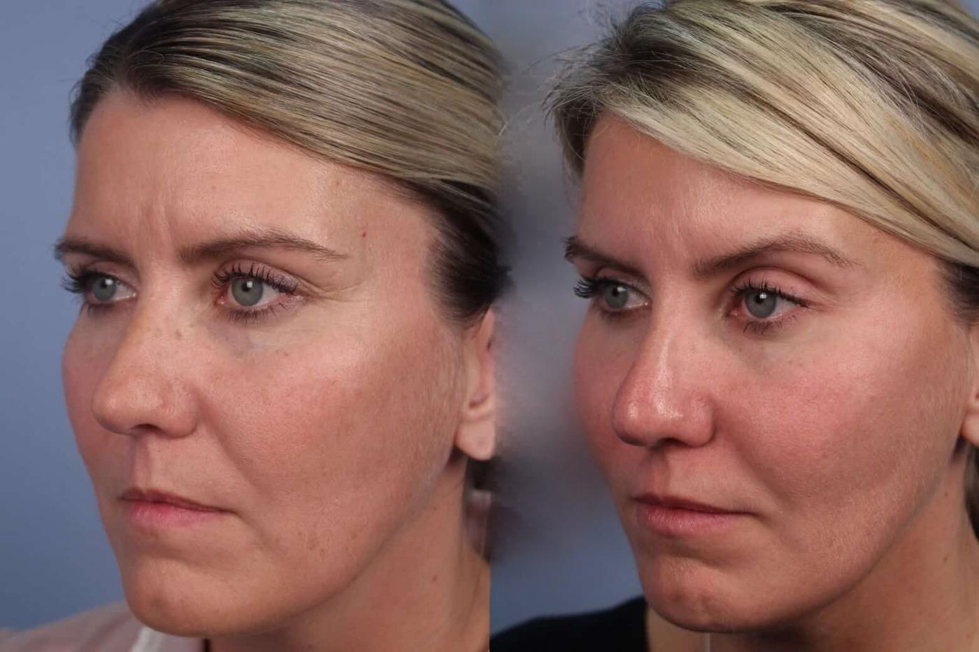 Dermal Fillers in Toronto Before and After. Image 40