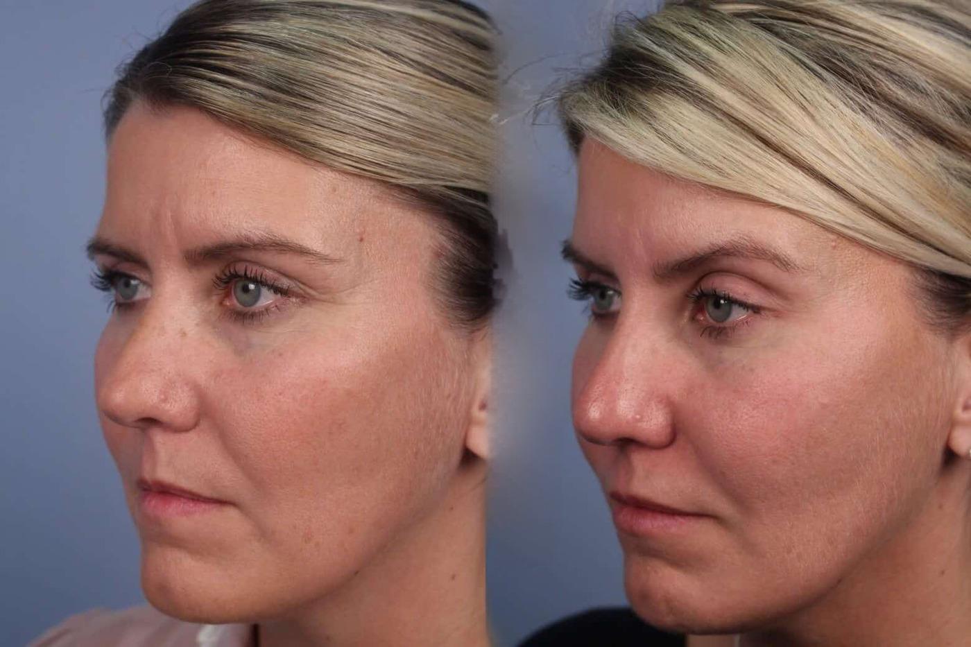 Dermal Fillers in Toronto Before and After. Image 41