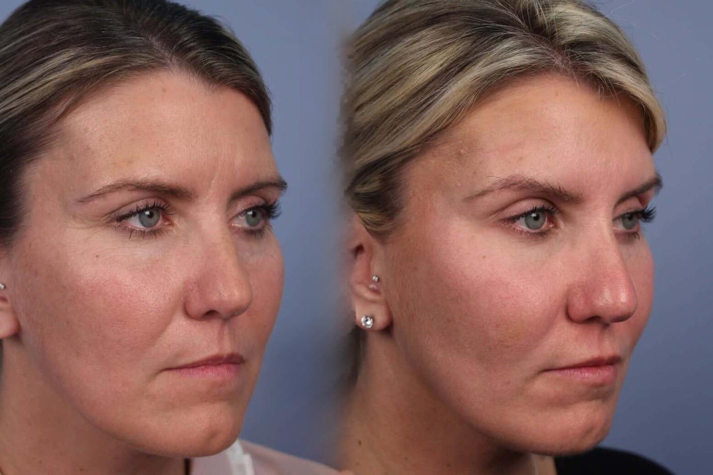Dermal Fillers in Toronto Before and After. Image 42