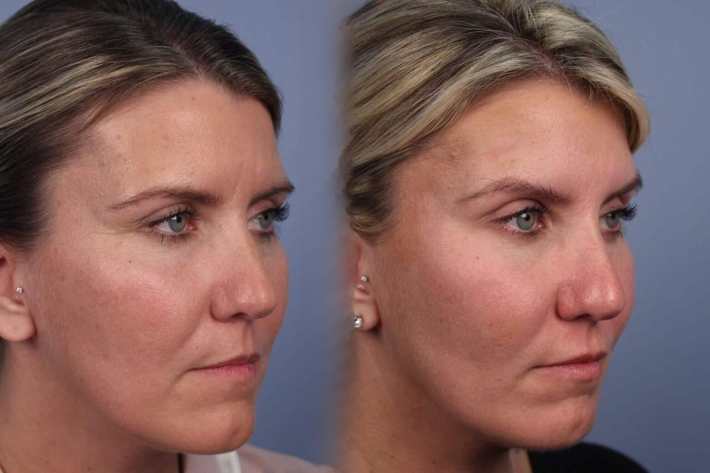 Dermal Fillers in Toronto Before and After. Image 43