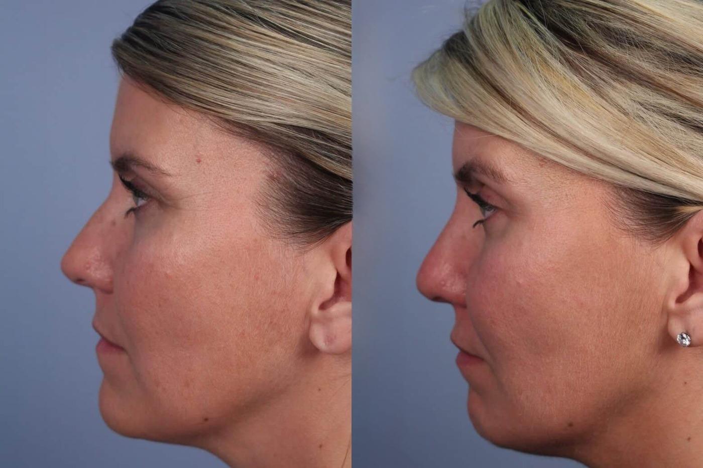 Dermal Fillers in Toronto Before and After. Image 44