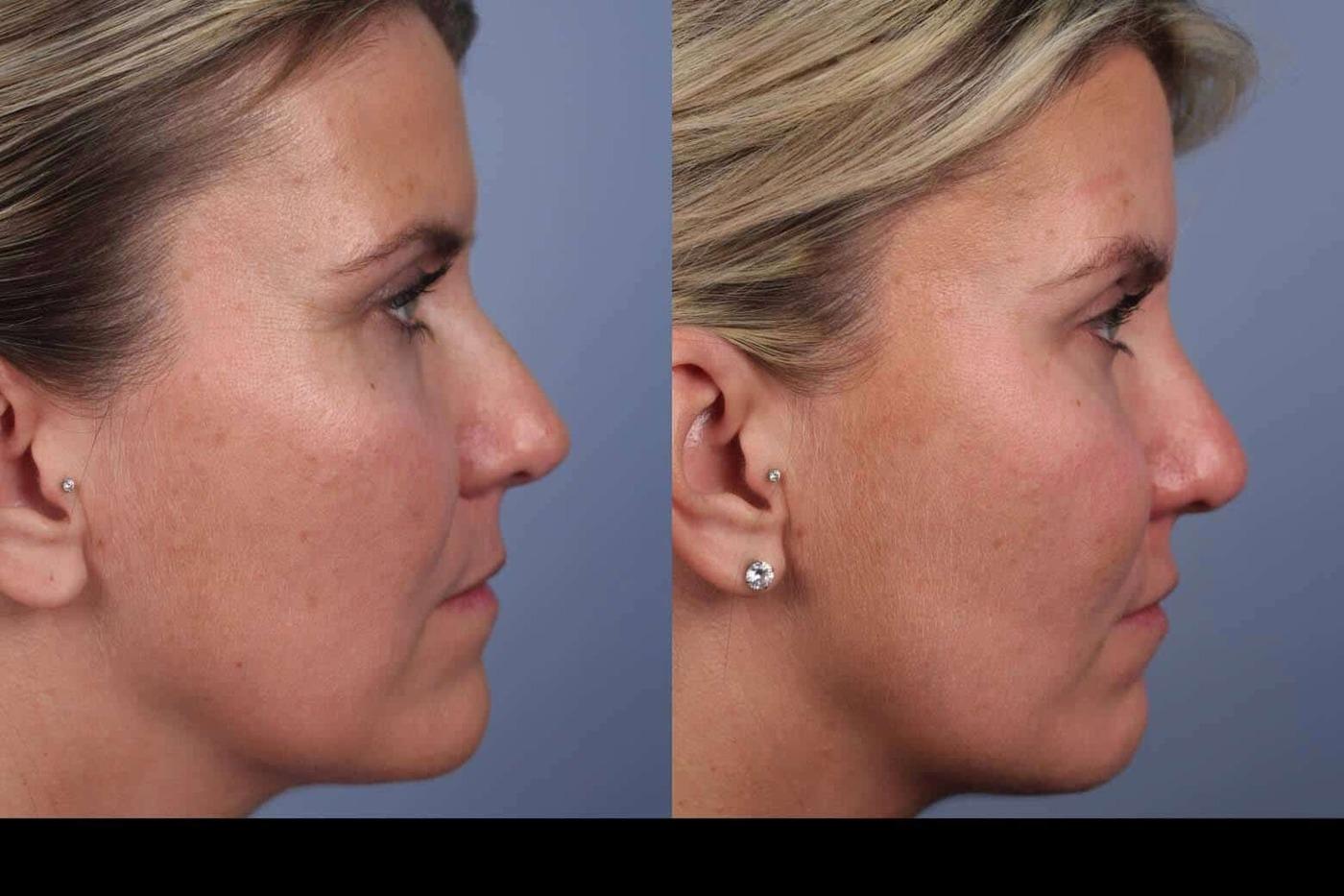 Dermal Fillers in Toronto Before and After. Image 45