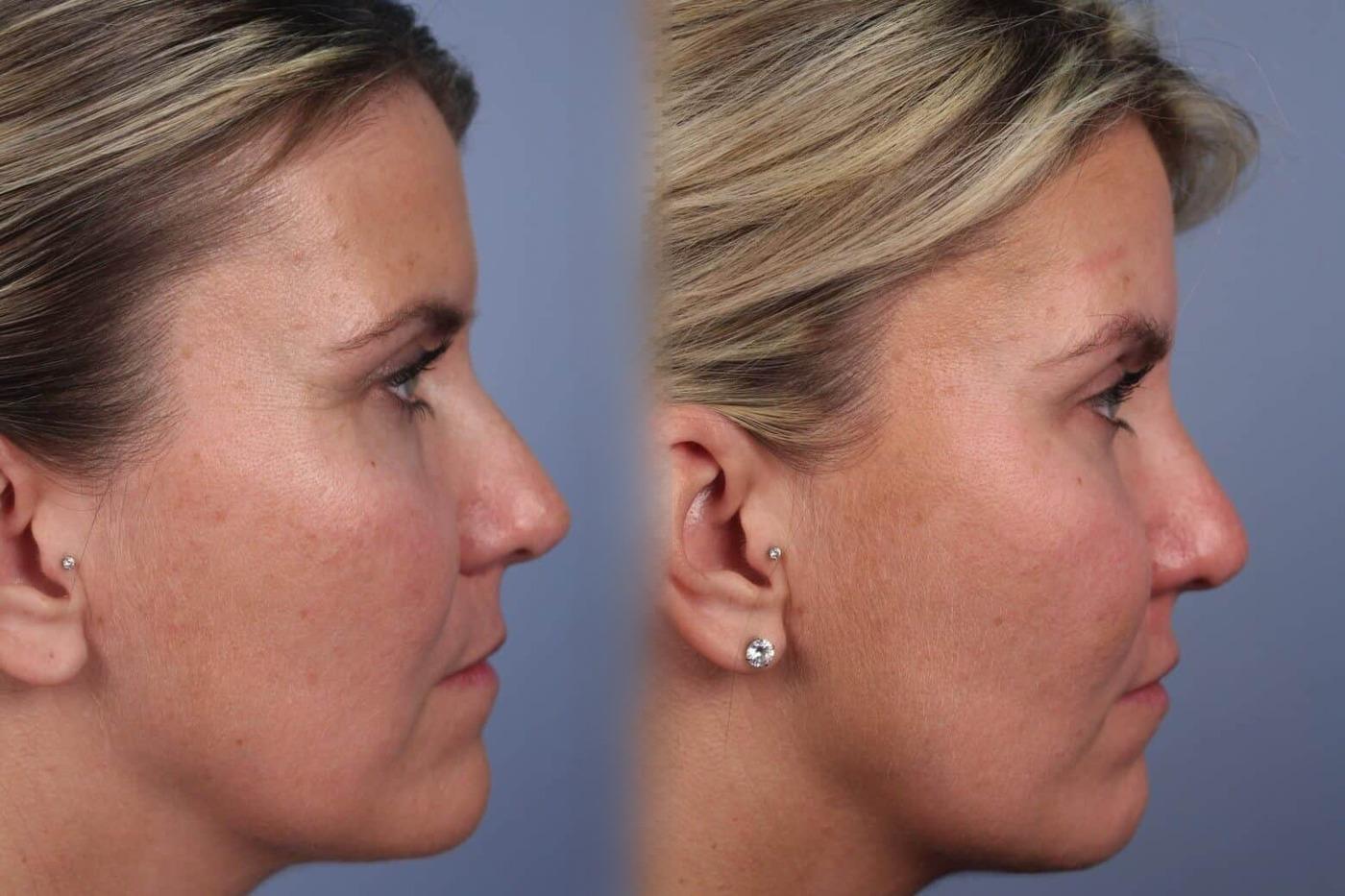 Dermal Fillers in Toronto Before and After. Image 46
