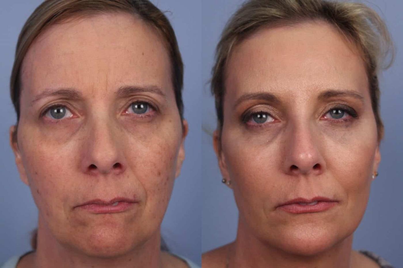 Dermal Fillers in Toronto Before and After. Image 47