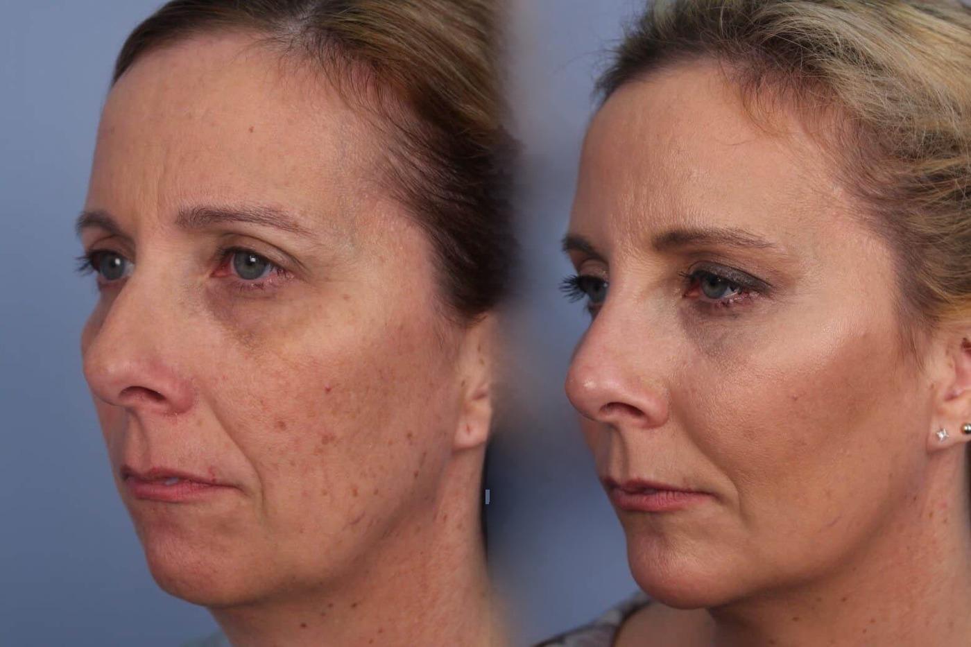 Dermal Fillers in Toronto Before and After. Image 48
