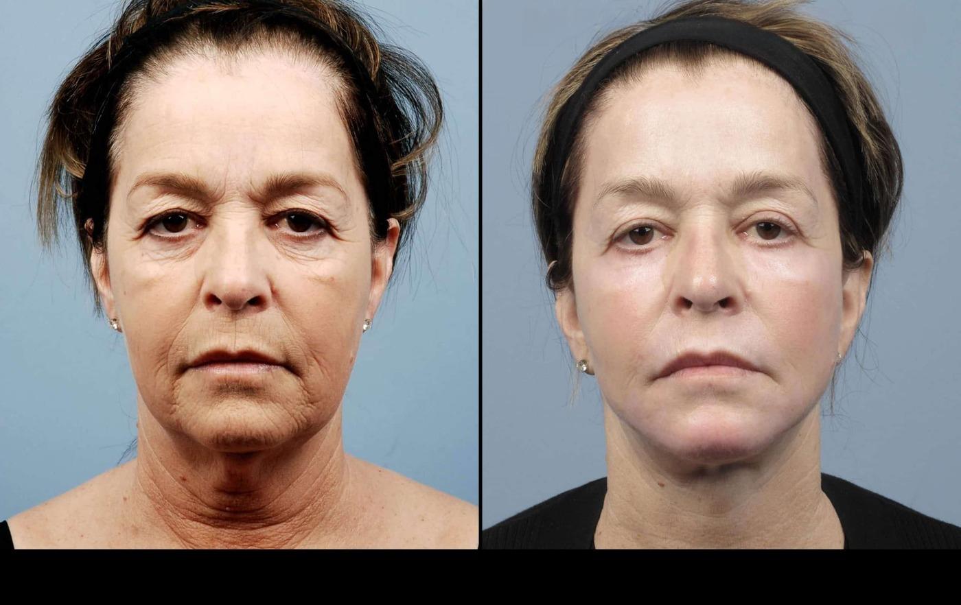 Dermal Fillers in Toronto Before and After. Image 5