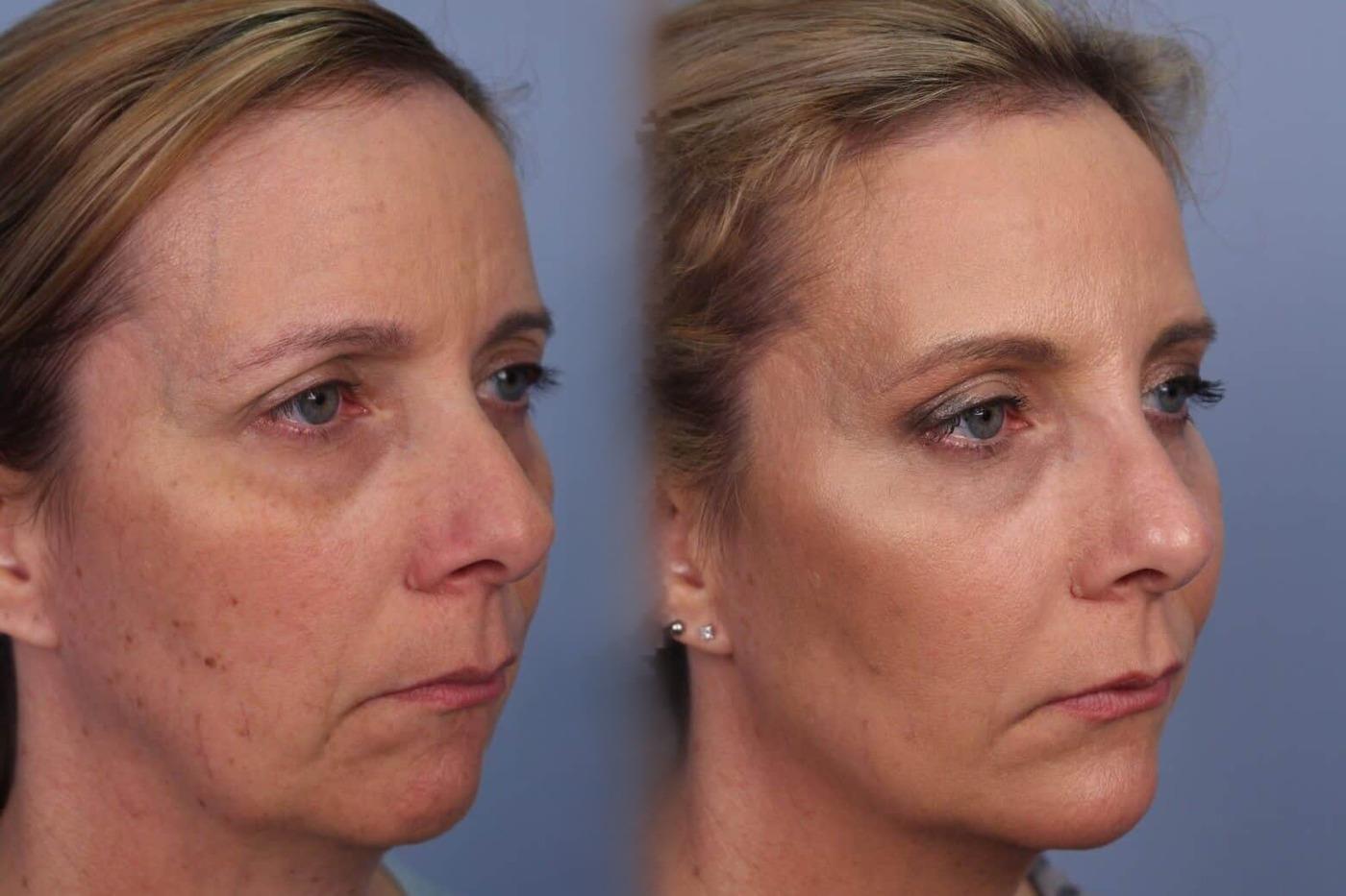 Dermal Fillers in Toronto Before and After. Image 51