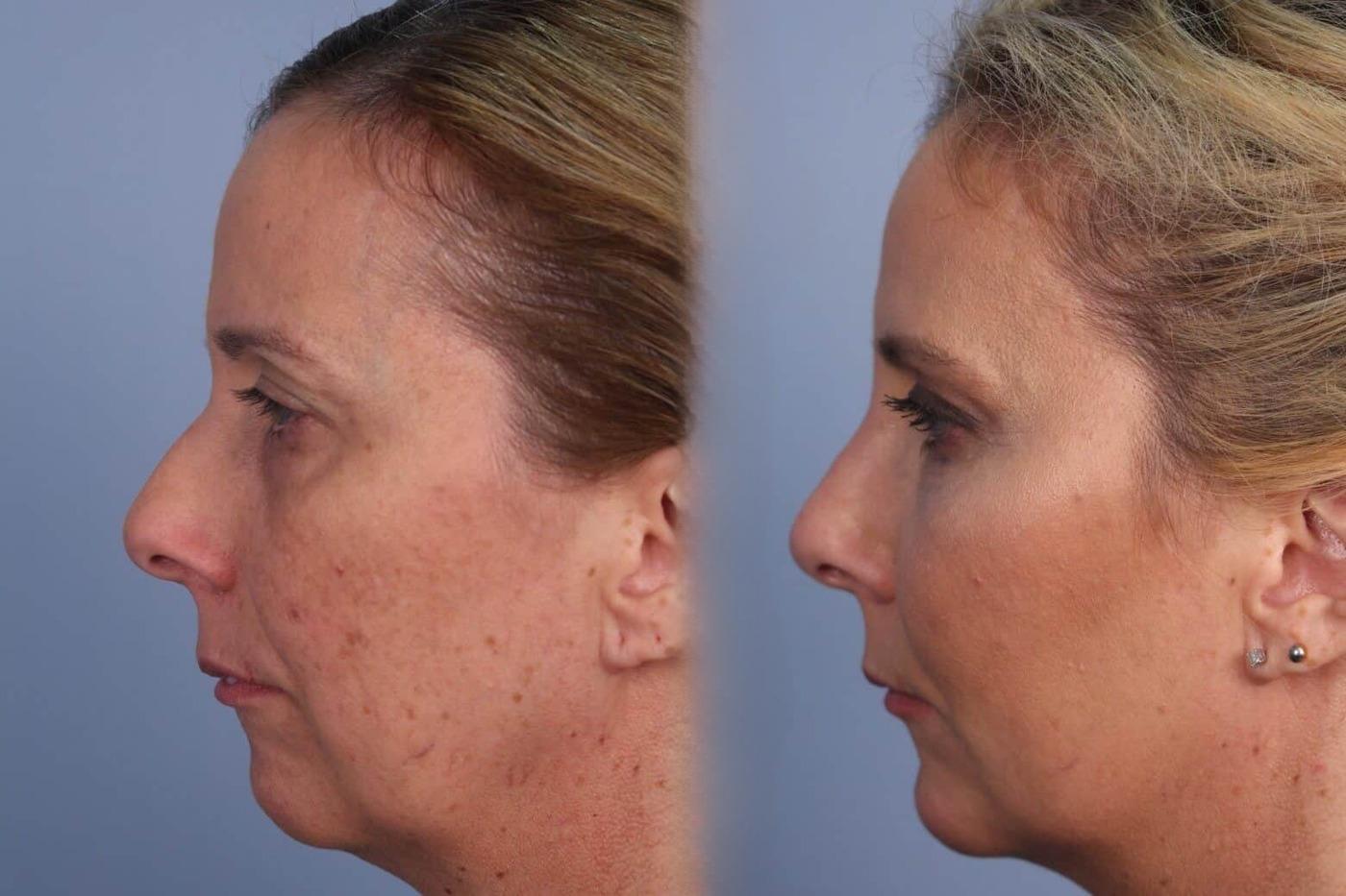 Dermal Fillers in Toronto Before and After. Image 52