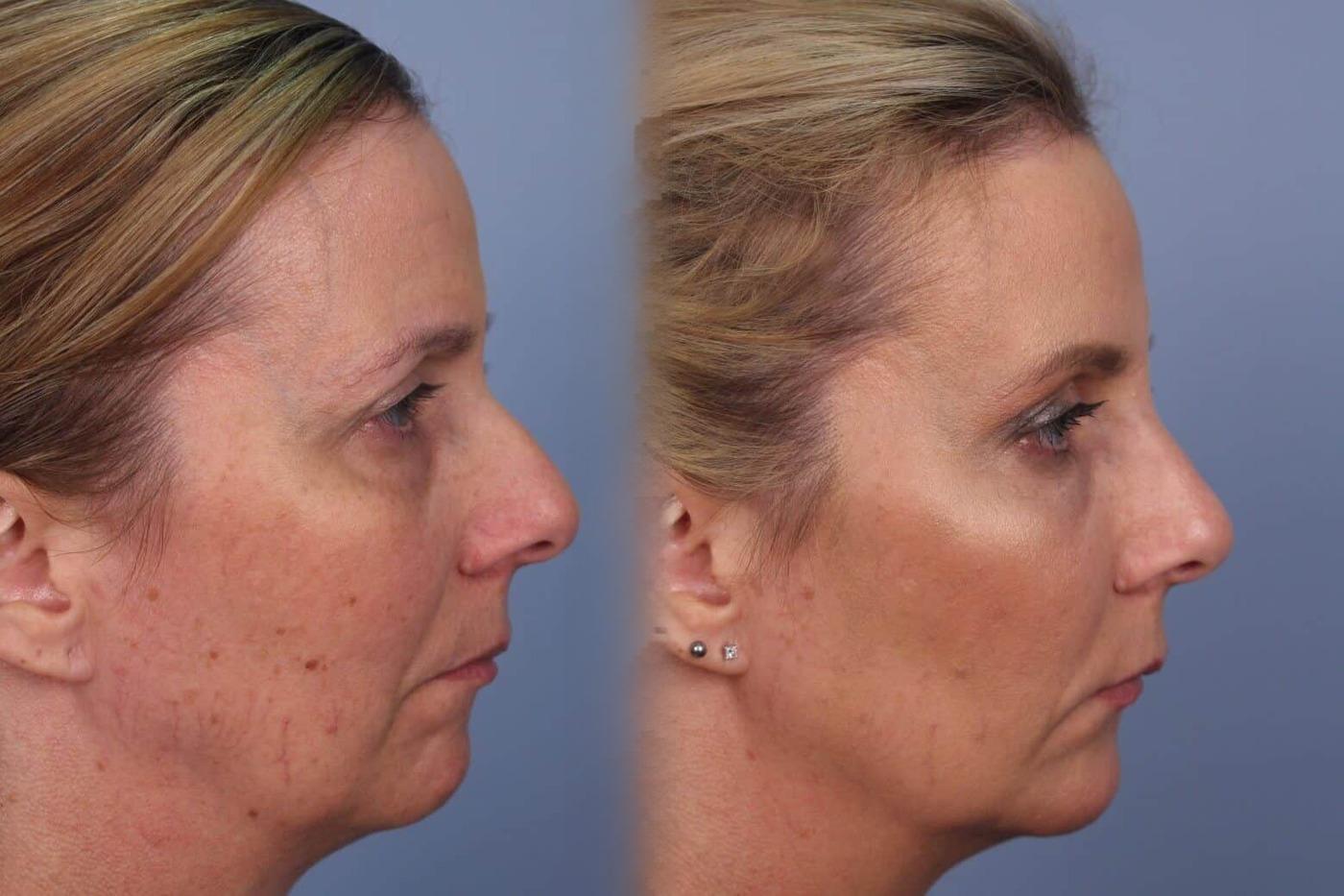 Dermal Fillers in Toronto Before and After. Image 53