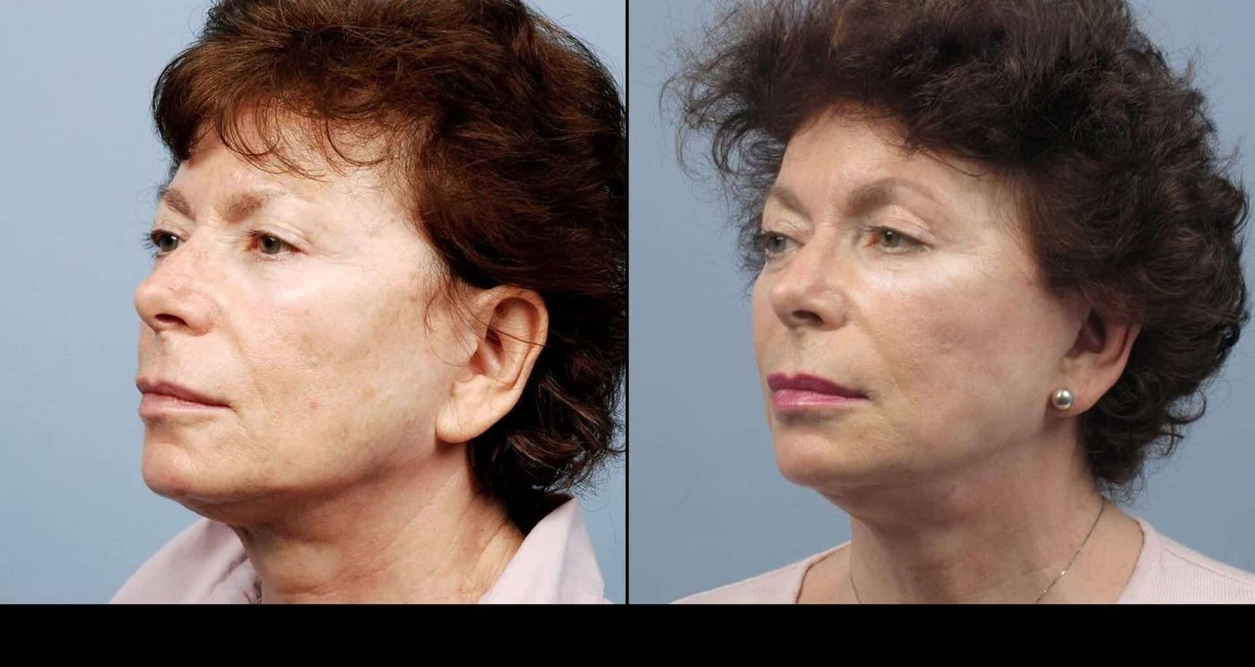 Dermal Fillers in Toronto Before and After. Image 54