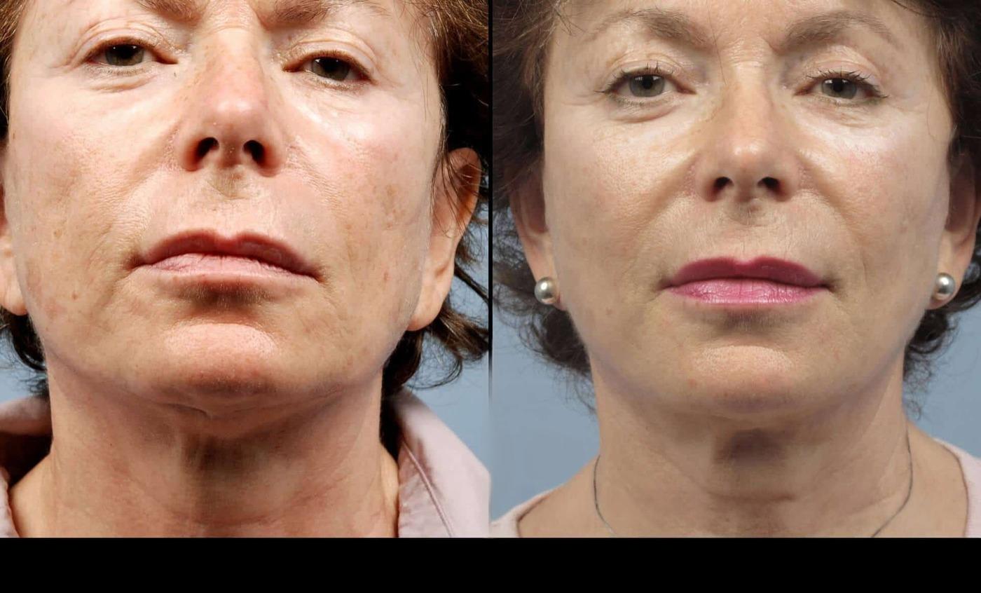 Dermal Fillers in Toronto Before and After. Image 55